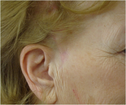 Skin cancer of the temporal region -after 6 months